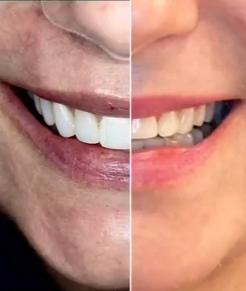 Antes e depois de paciente